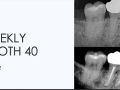 2. Weekly Tooth 40 - Apical Periodontitis/ Fracture?/ No Treatment