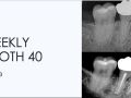 3. Weekly Tooth 40 - Acute Sinusitis/ Pulp Capping/ Incomplete Endo