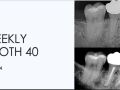 4. Weekly Tooth 40 - Missing Crown/ Rubber Dam/ Root Fracture
