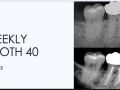 5. Weekly Tooth 40 - Internal Resorption/ Bite Sensitivity/ Anatomy
