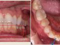 ALIGNER/ORTHO CASE SELECTION PT. 2 AND PAOO