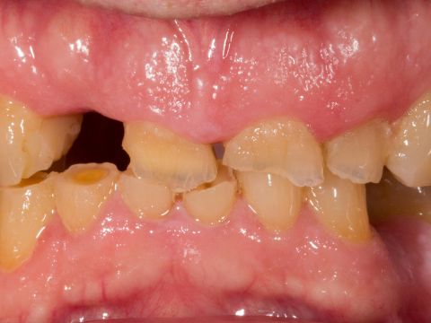 Determining Vertical Dimension for Worn Dentition Case