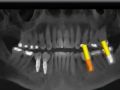 How to Place Implant Parallel to Existing Implant